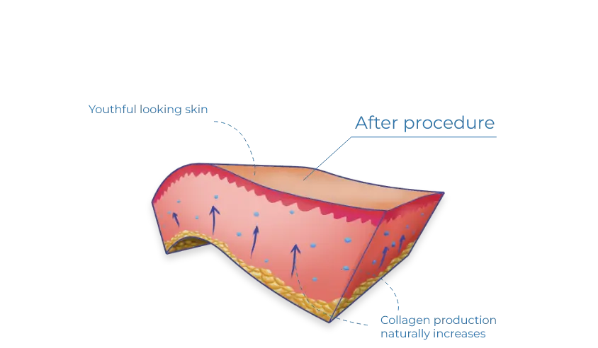 Chemical Peel Explanation