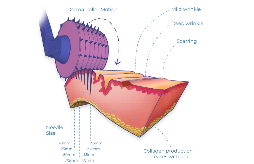 Microdermabrasion Visualization